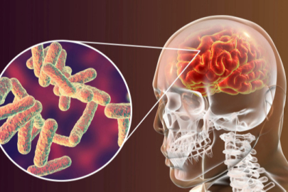 Zonguldak’ta ikinci menenjit vakası!
