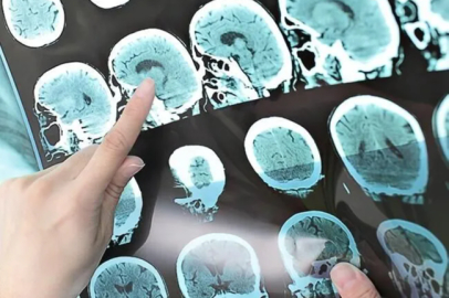 Kadınlarda erkeklerden 2-3 kat daha fazla görülüyor!